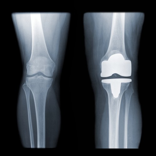 Totale Knieprothese